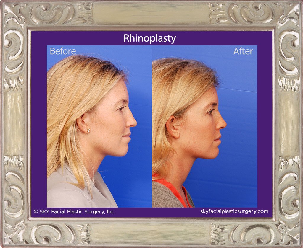 SKY-Facial-Plastic-Surgery-Rhinoplasty-42E.jpg