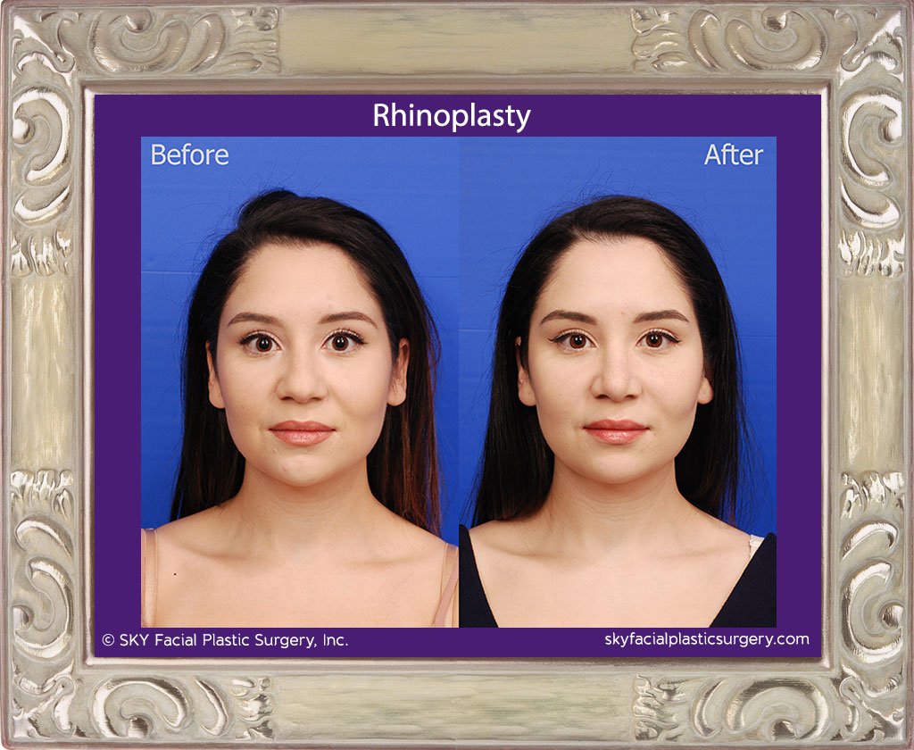 SKY-Facial-Plastic-Surgery-Rhinoplasty-43A.jpg