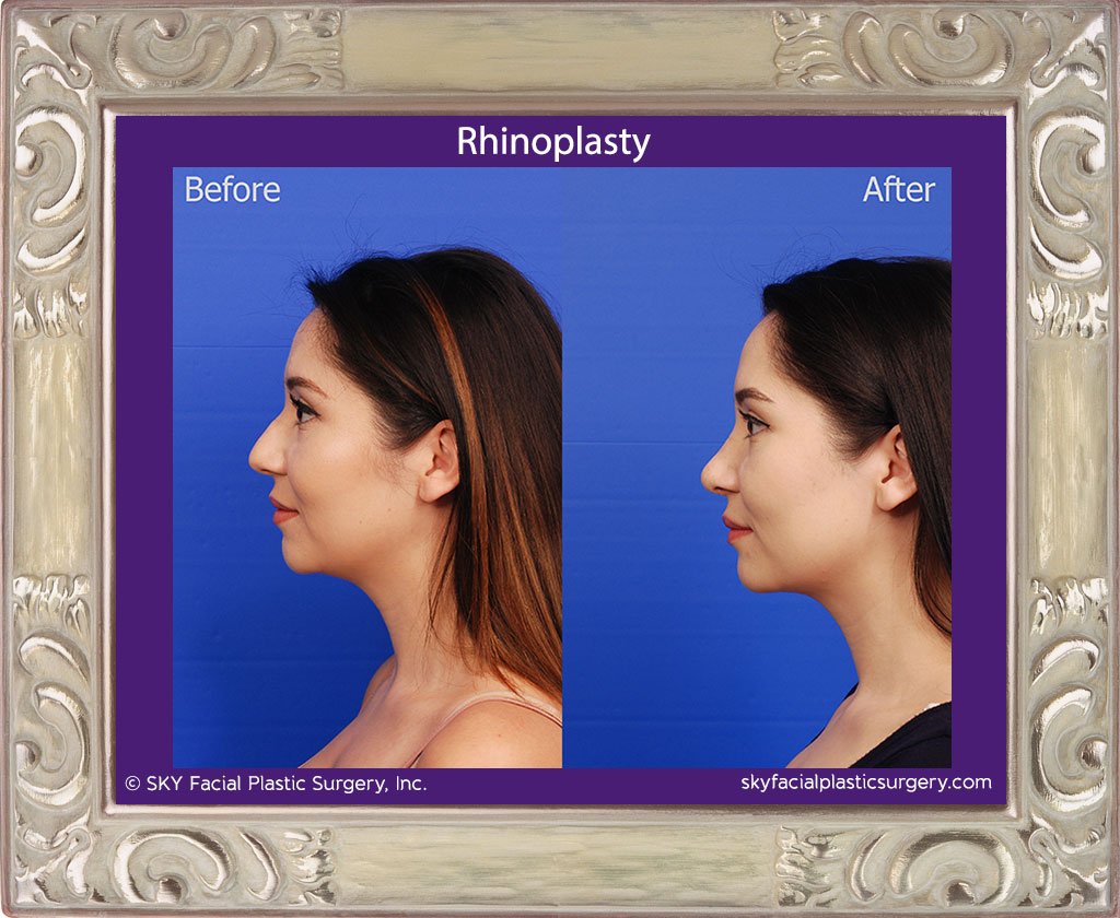 SKY-Facial-Plastic-Surgery-Rhinoplasty-43B.jpg