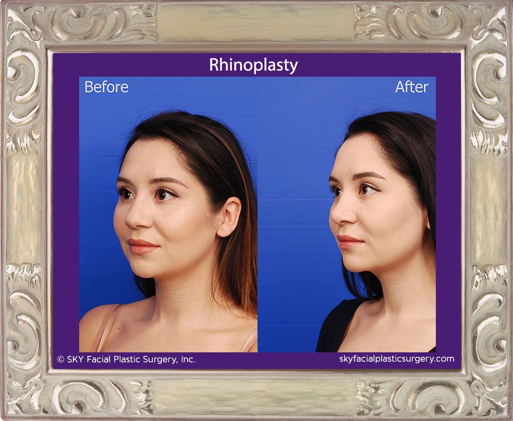 SKY-Facial-Plastic-Surgery-Rhinoplasty-43C.jpg