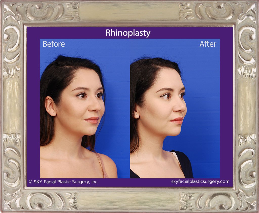 SKY-Facial-Plastic-Surgery-Rhinoplasty-43D.jpg