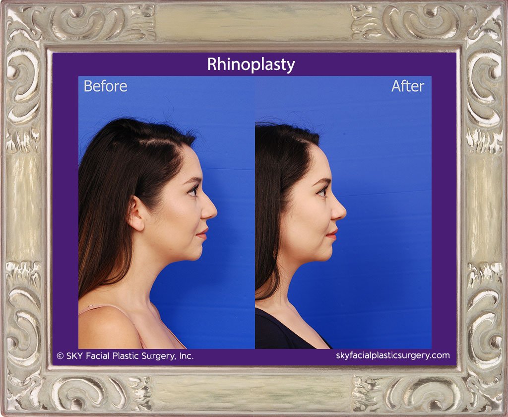 SKY-Facial-Plastic-Surgery-Rhinoplasty-43E.jpg