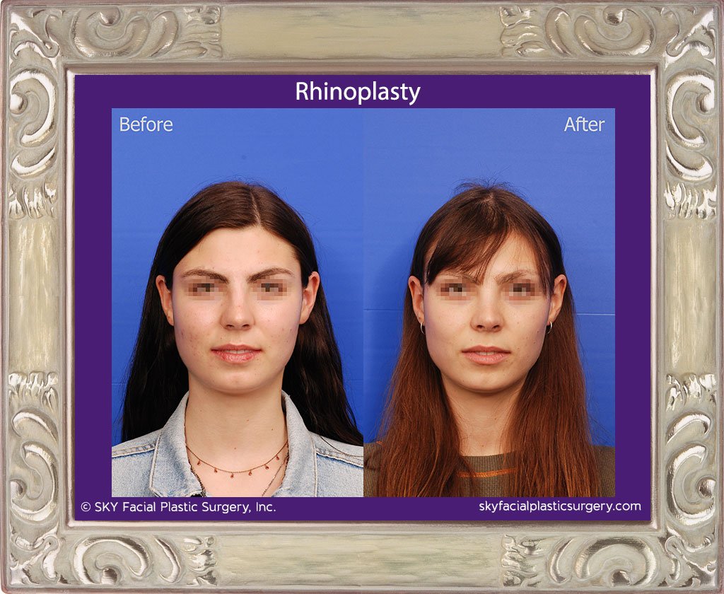 SKY-Facial-Plastic-Surgery-Rhinoplasty-44A.jpg