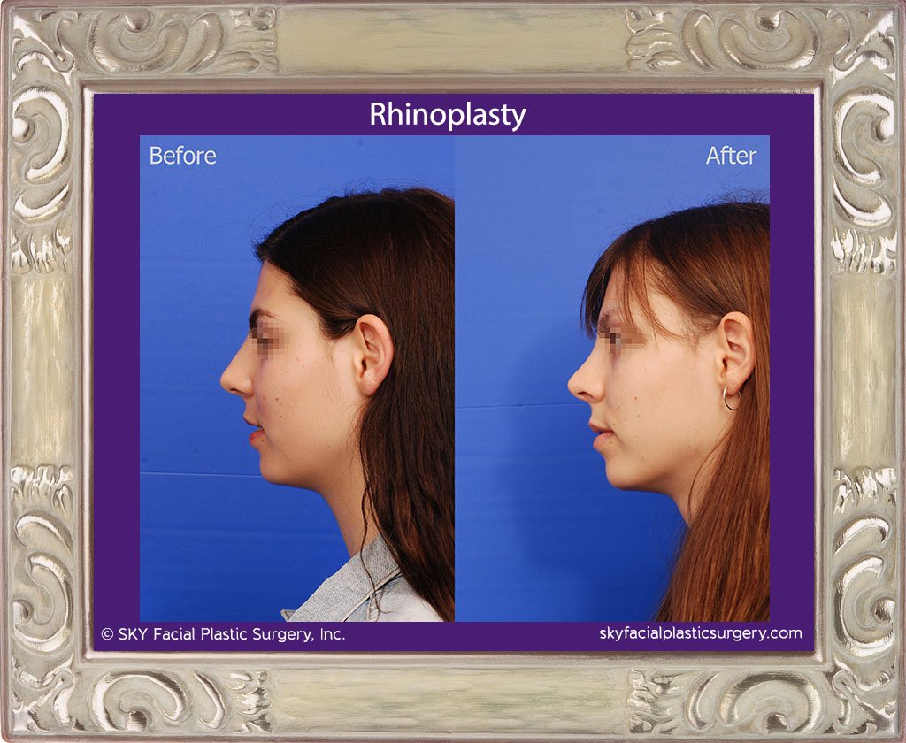 SKY-Facial-Plastic-Surgery-Rhinoplasty-44B.jpg