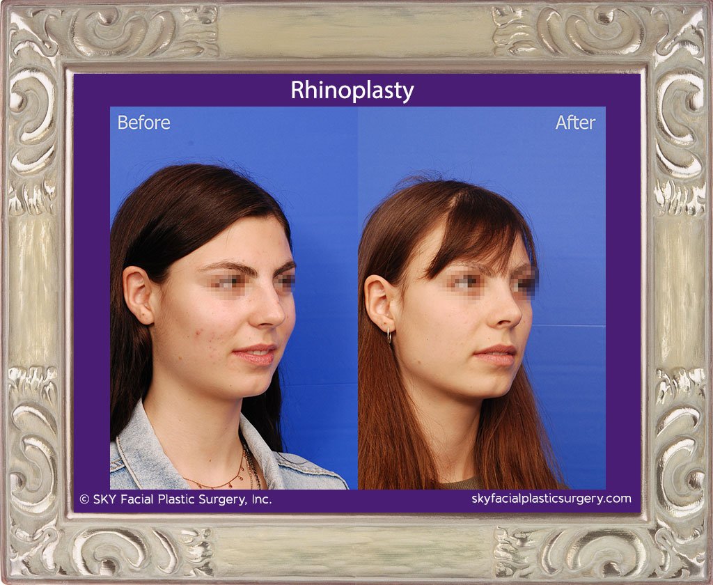 SKY-Facial-Plastic-Surgery-Rhinoplasty-44D.jpg