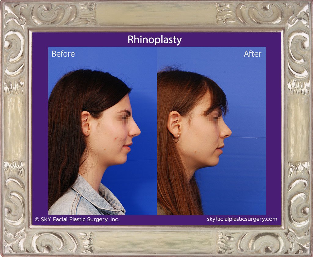 SKY-Facial-Plastic-Surgery-Rhinoplasty-44E.jpg