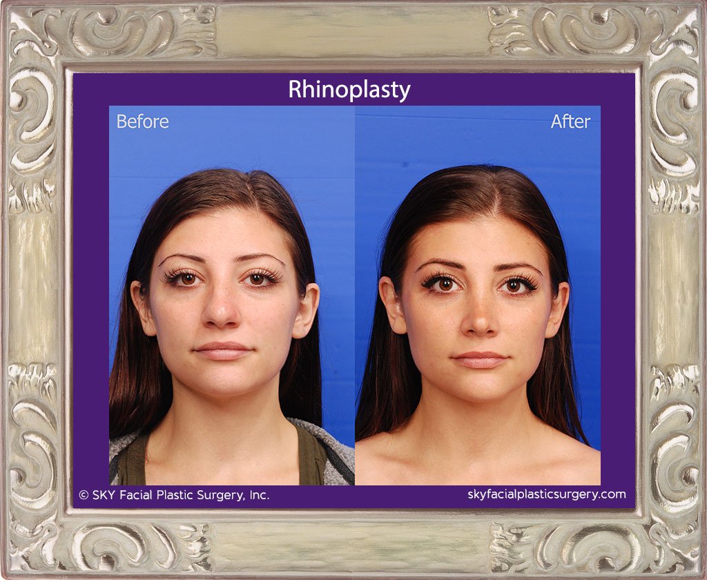 SKY-Facial-Plastic-Surgery-Rhinoplasty-45A.jpg
