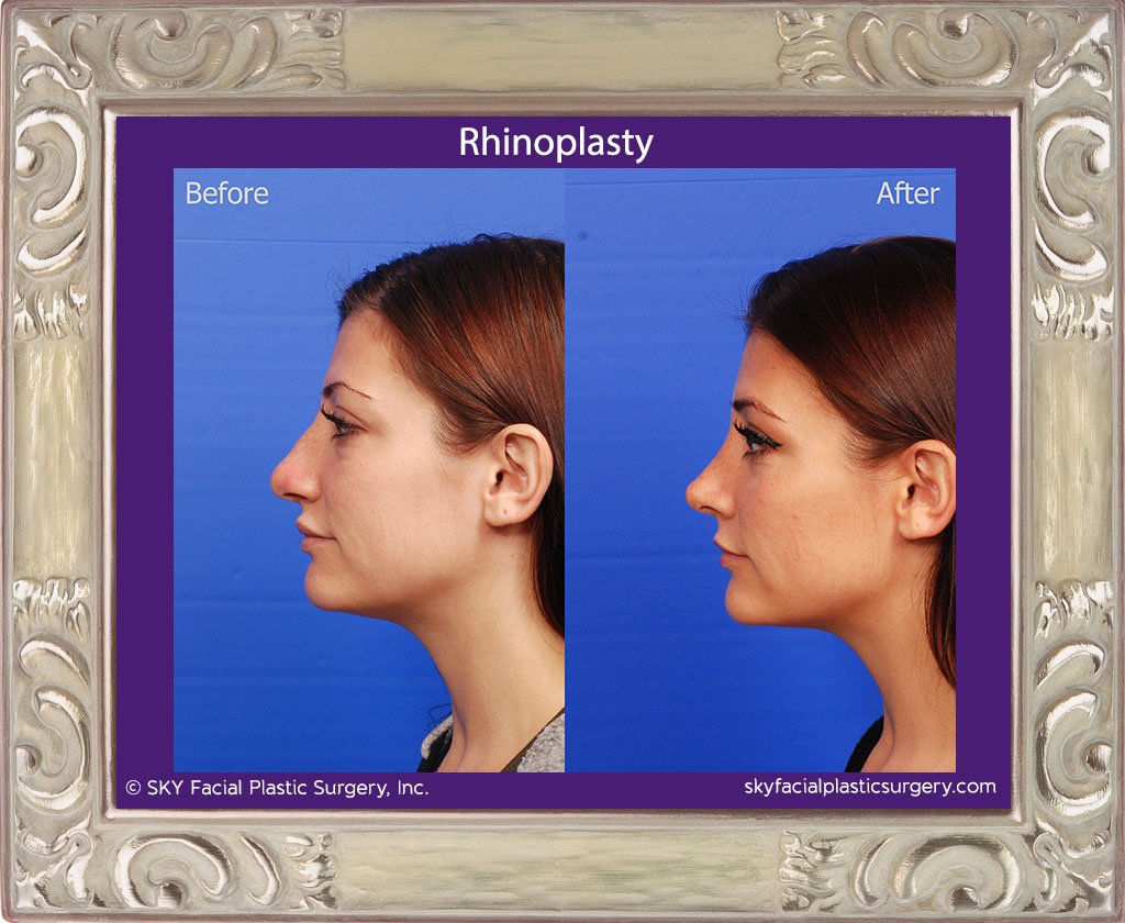 SKY-Facial-Plastic-Surgery-Rhinoplasty-45B.jpg