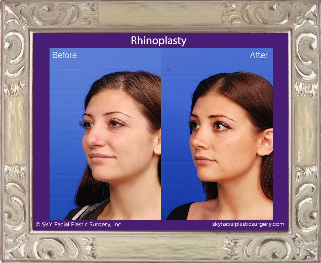 SKY-Facial-Plastic-Surgery-Rhinoplasty-45C.jpg