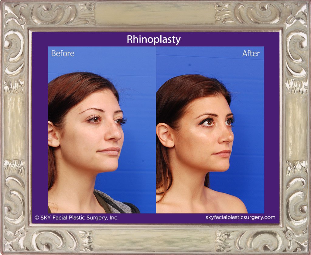SKY-Facial-Plastic-Surgery-Rhinoplasty-45D.jpg