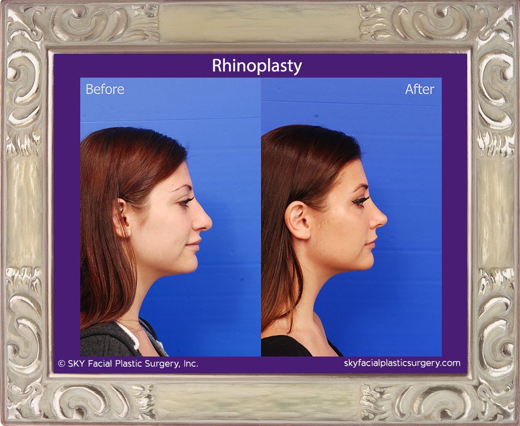 SKY-Facial-Plastic-Surgery-Rhinoplasty-45E.jpg