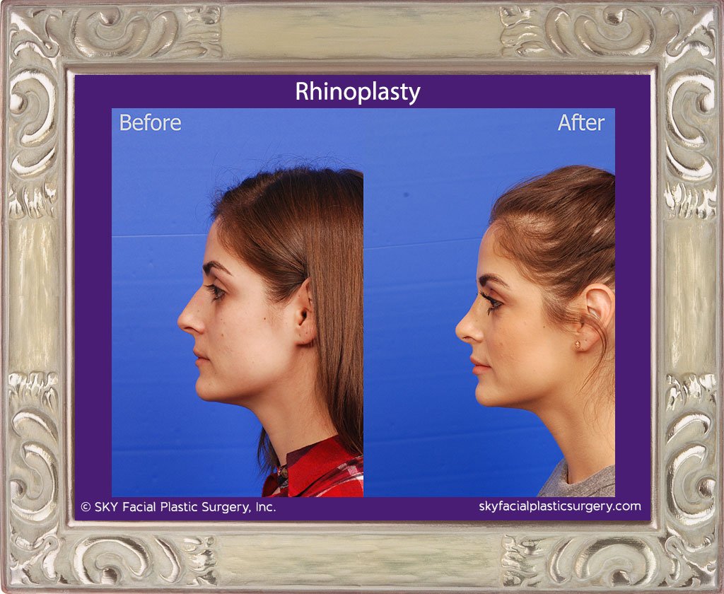 SKY-Facial-Plastic-Surgery-Rhinoplasty-46B.jpg