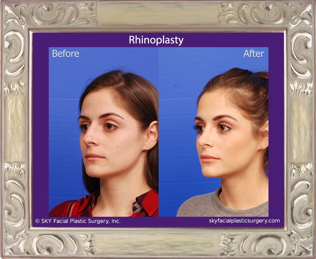 SKY-Facial-Plastic-Surgery-Rhinoplasty-46C.jpg