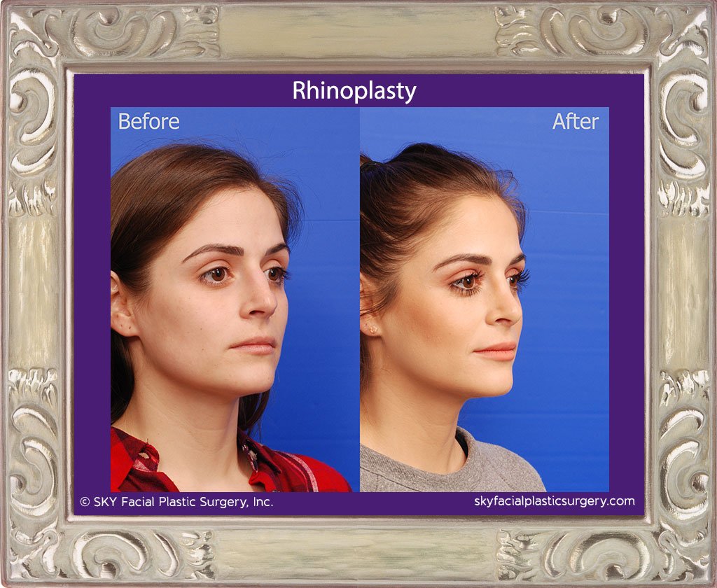 SKY-Facial-Plastic-Surgery-Rhinoplasty-46D.jpg
