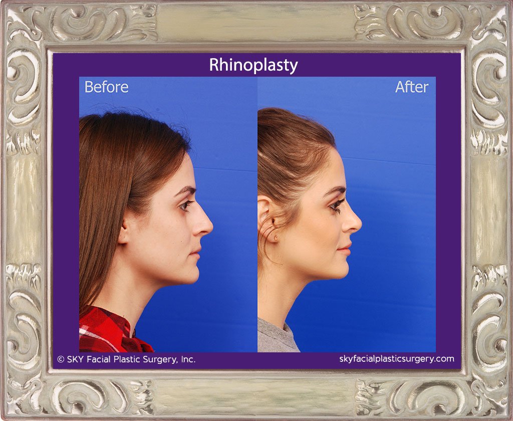 SKY-Facial-Plastic-Surgery-Rhinoplasty-46E.jpg