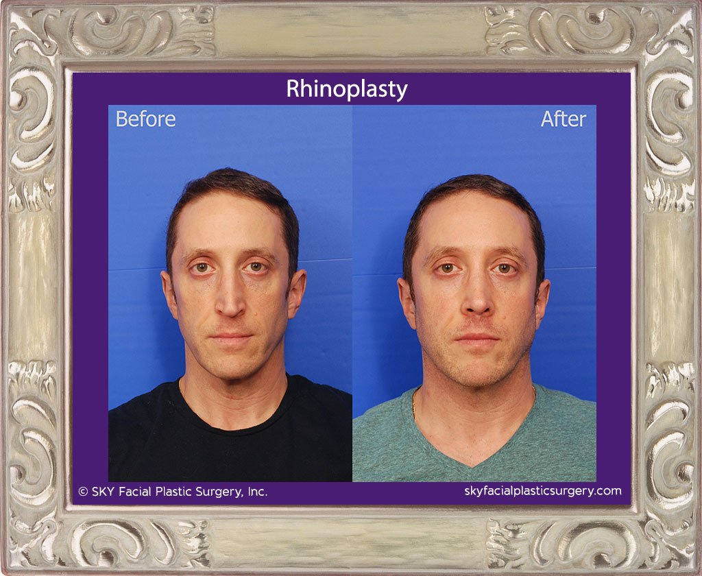 SKY-Facial-Plastic-Surgery-Rhinoplasty-47A.jpg
