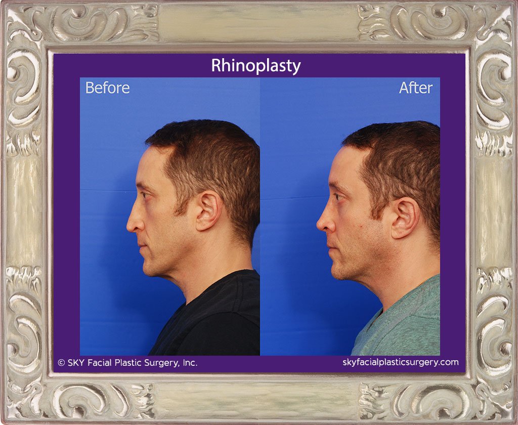 SKY-Facial-Plastic-Surgery-Rhinoplasty-47B.jpg