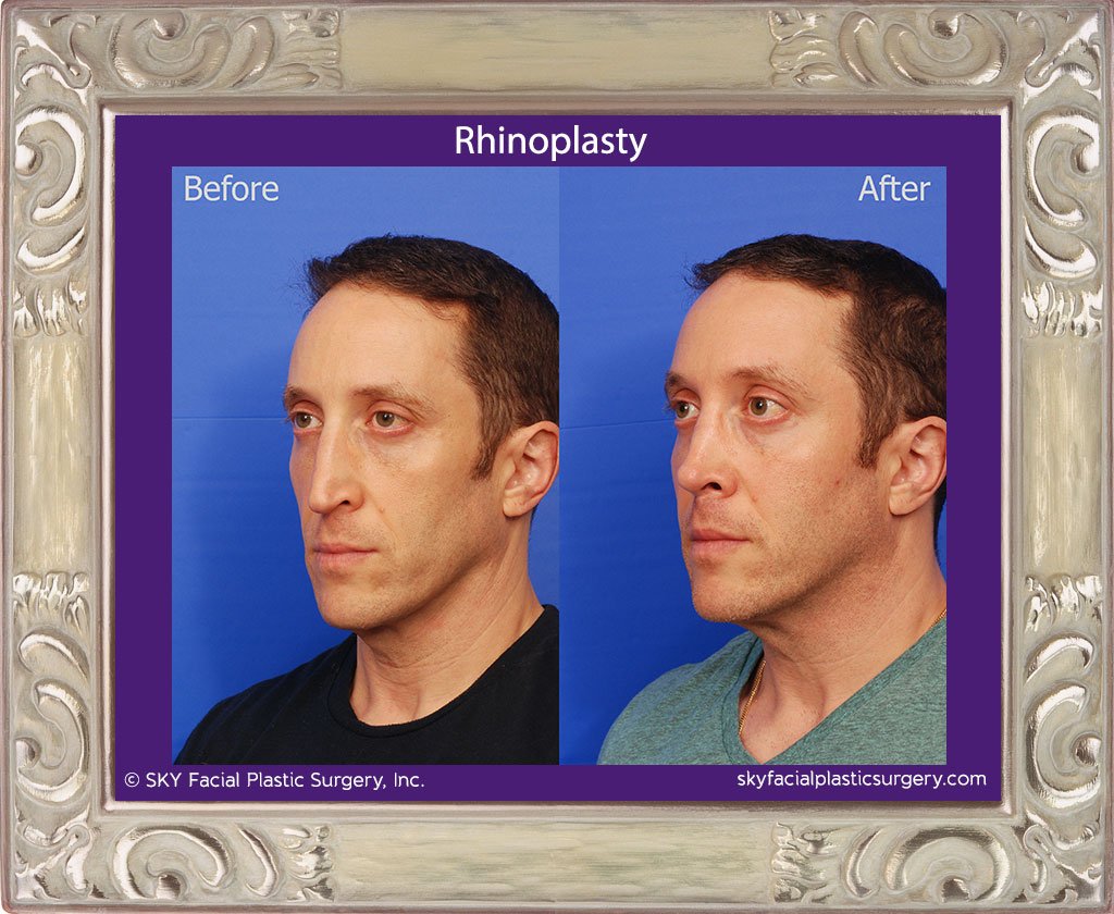 SKY-Facial-Plastic-Surgery-Rhinoplasty-47C.jpg