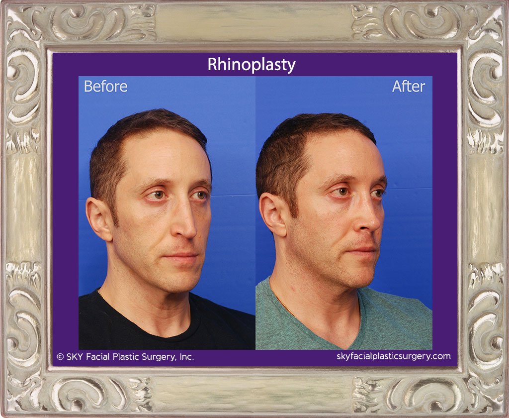 SKY-Facial-Plastic-Surgery-Rhinoplasty-47D.jpg