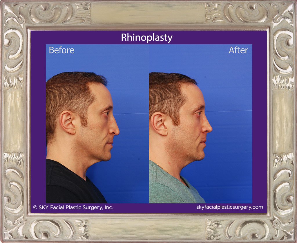 SKY-Facial-Plastic-Surgery-Rhinoplasty-47E.jpg
