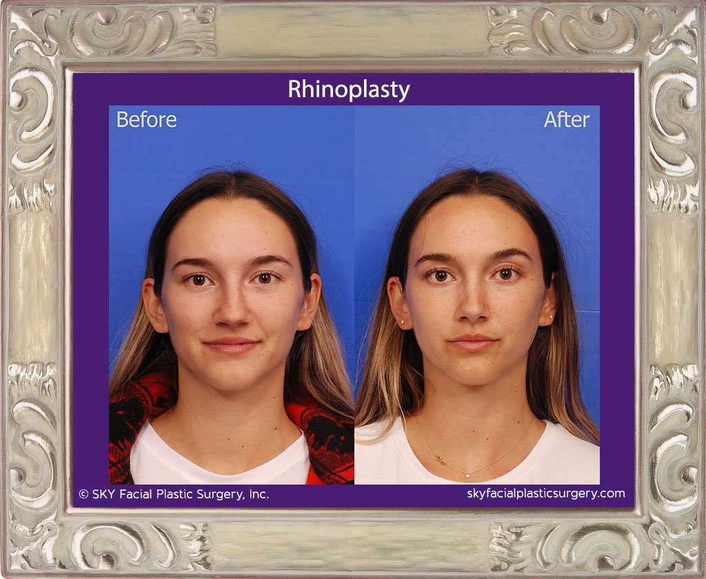 SKY-Facial-Plastic-Surgery-Rhinoplasty-48A.jpg
