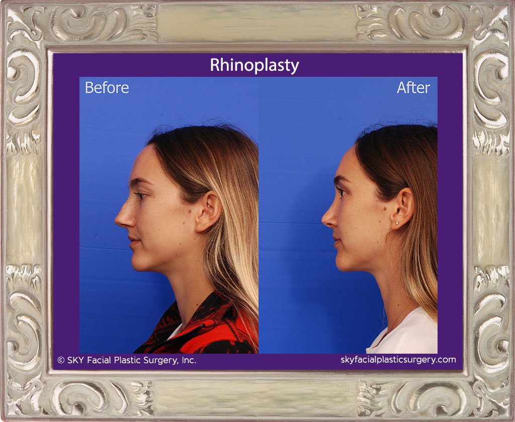 SKY-Facial-Plastic-Surgery-Rhinoplasty-48B.jpg