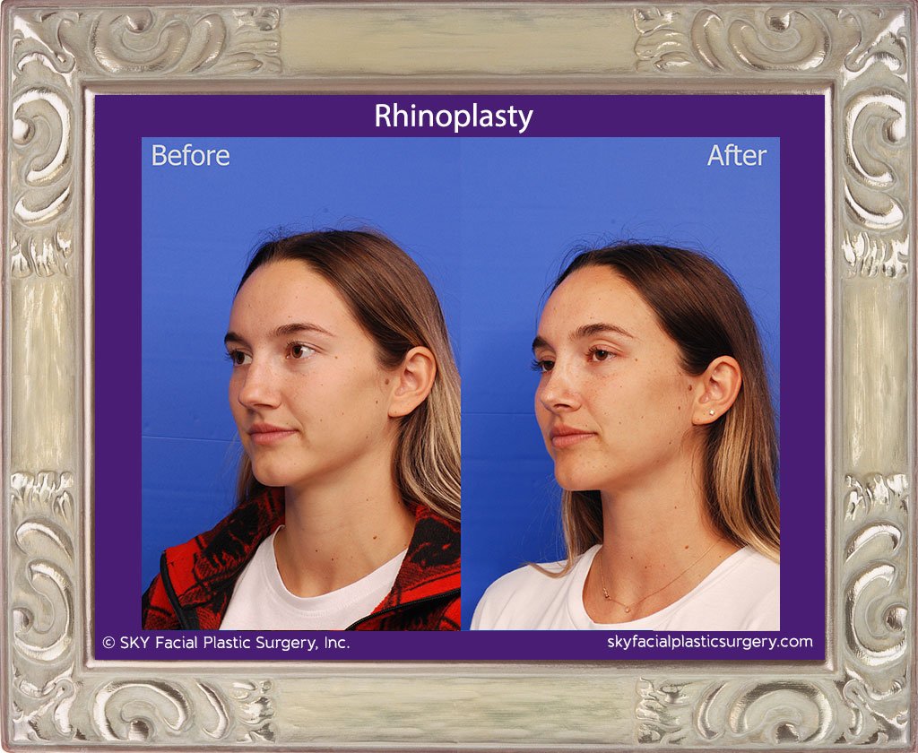 SKY-Facial-Plastic-Surgery-Rhinoplasty-48C.jpg