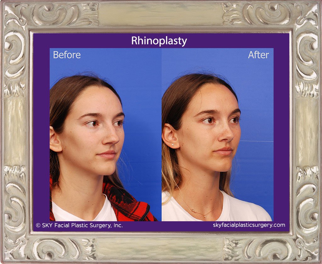 SKY-Facial-Plastic-Surgery-Rhinoplasty-48D.jpg