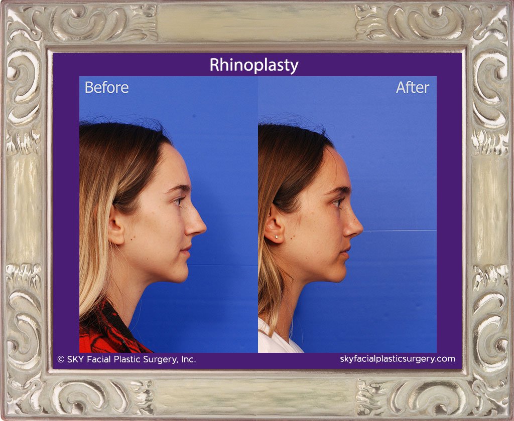 SKY-Facial-Plastic-Surgery-Rhinoplasty-48E.jpg