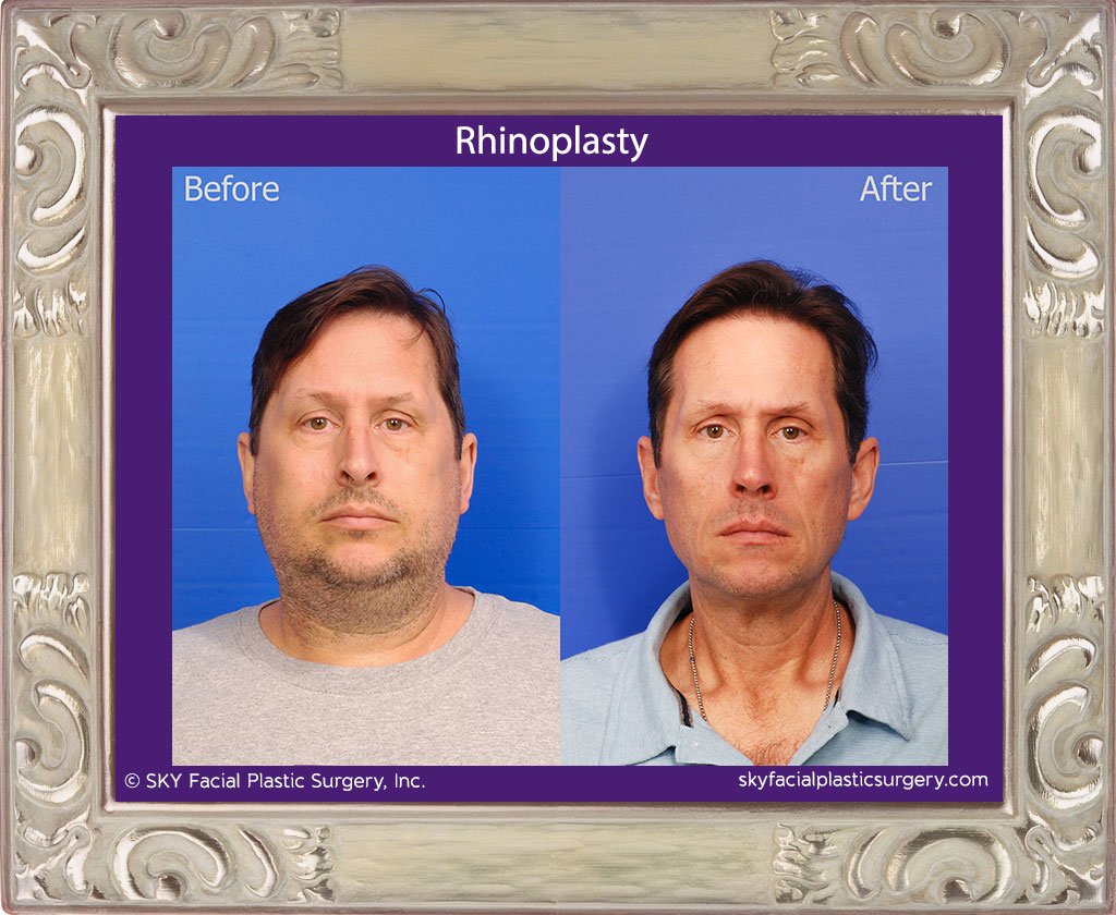 SKY-Facial-Plastic-Surgery-Rhinoplasty-49A.jpg