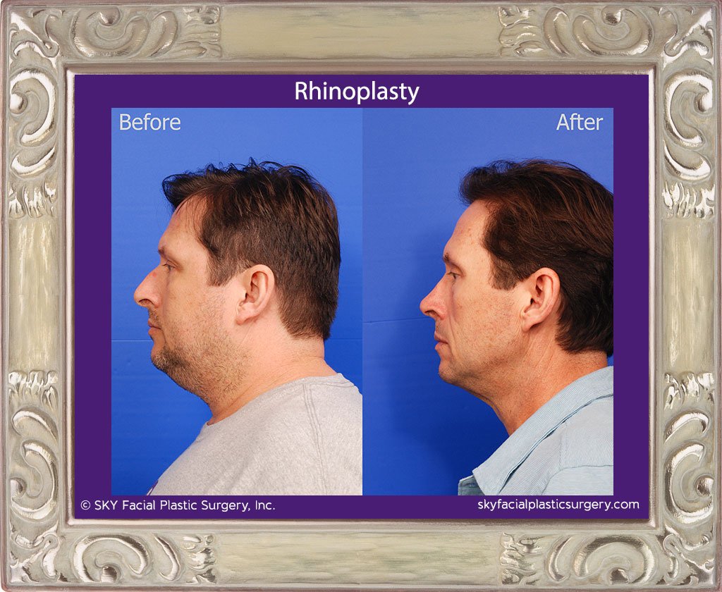 SKY-Facial-Plastic-Surgery-Rhinoplasty-49B.jpg