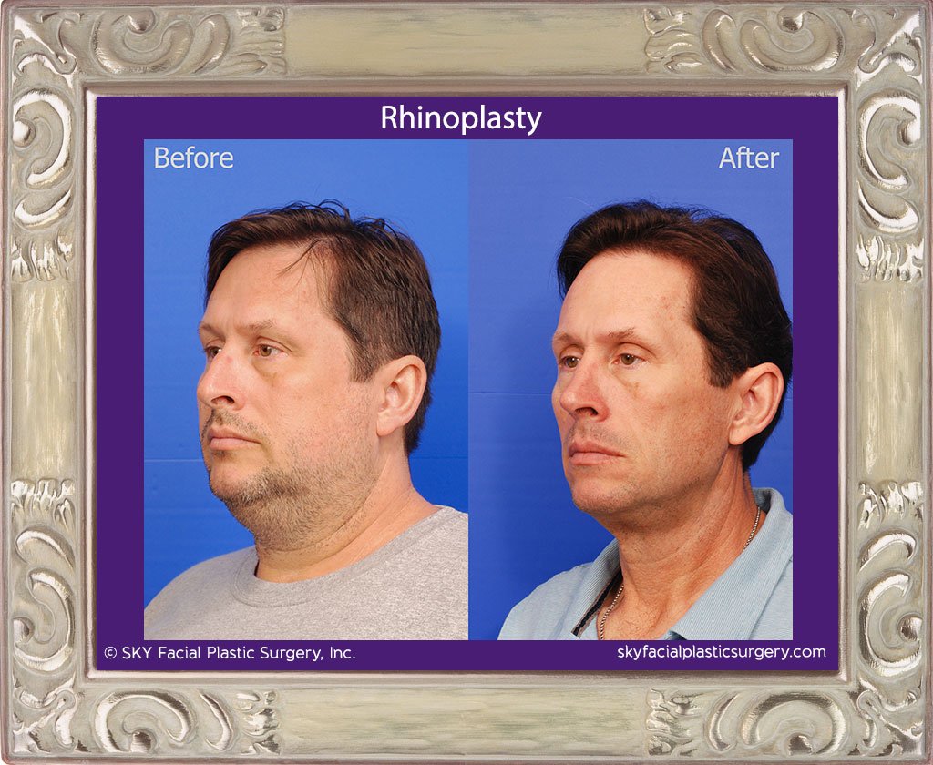SKY-Facial-Plastic-Surgery-Rhinoplasty-49C.jpg