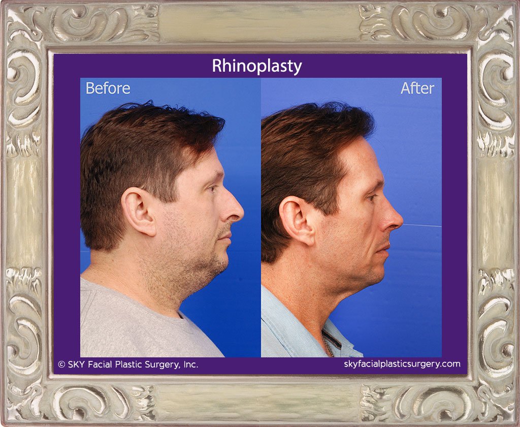 SKY-Facial-Plastic-Surgery-Rhinoplasty-49D.jpg