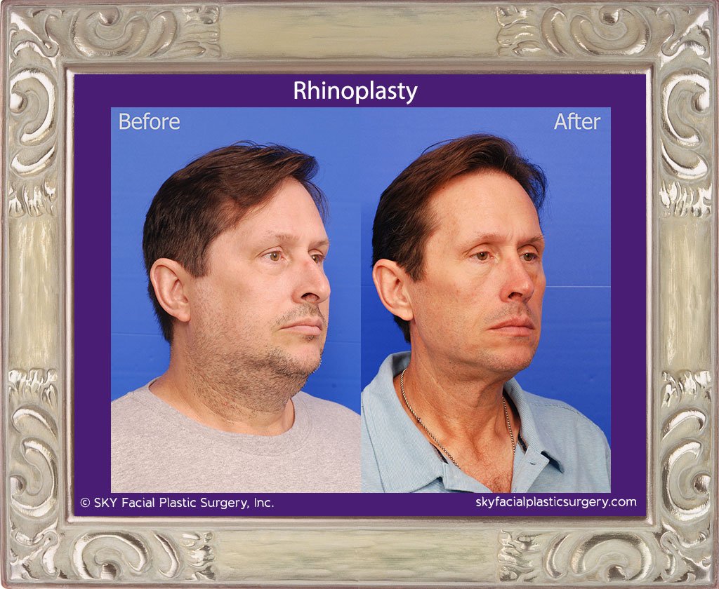 SKY-Facial-Plastic-Surgery-Rhinoplasty-49E.jpg