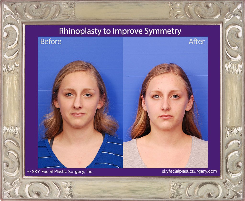 SKY-Facial-Plastic-Surgery-Rhinoplasty-50A.jpg