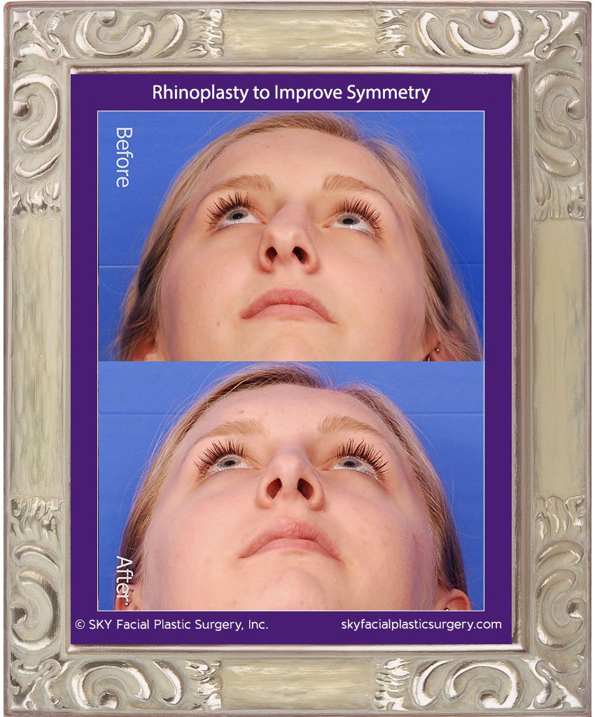 SKY-Facial-Plastic-Surgery-Rhinoplasty-50B.jpg