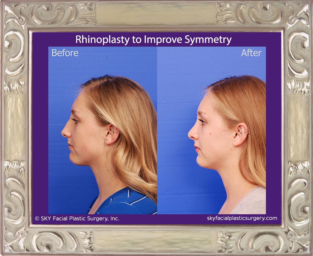 SKY-Facial-Plastic-Surgery-Rhinoplasty-50C.jpg