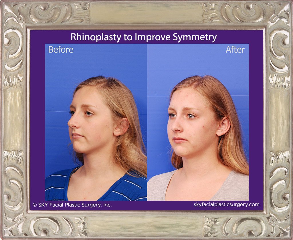 SKY-Facial-Plastic-Surgery-Rhinoplasty-50D.jpg