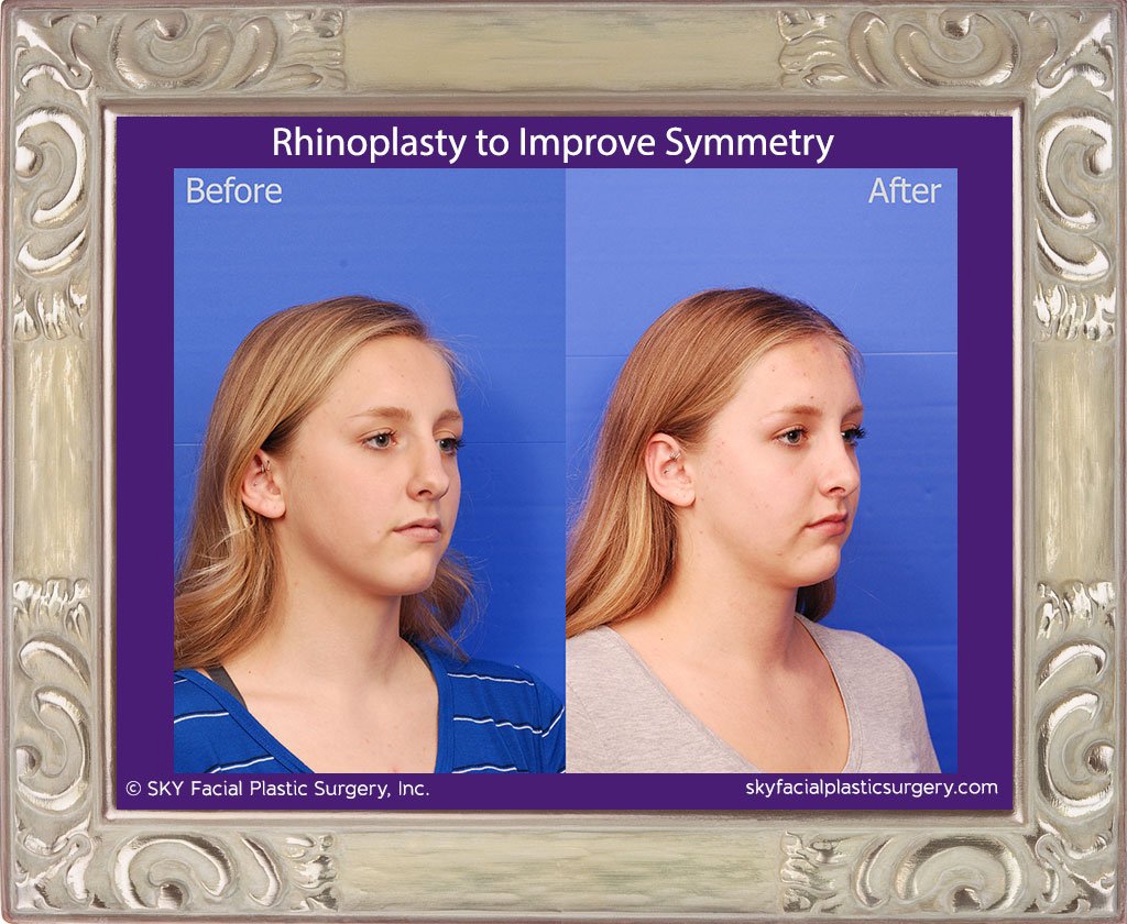 SKY-Facial-Plastic-Surgery-Rhinoplasty-50E.jpg