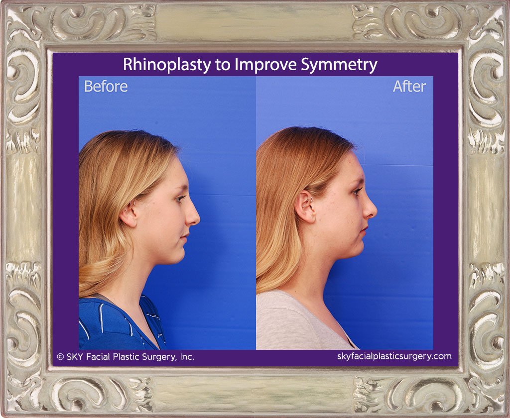 SKY-Facial-Plastic-Surgery-Rhinoplasty-50F.jpg