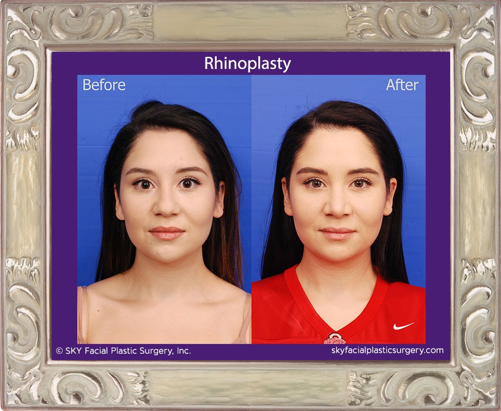 SKY-Facial-Plastic-Surgery-Rhinoplasty-51A.jpg