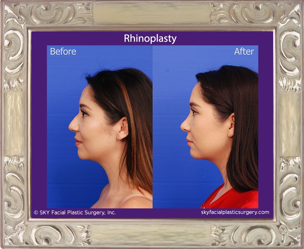 SKY-Facial-Plastic-Surgery-Rhinoplasty-51B.jpg