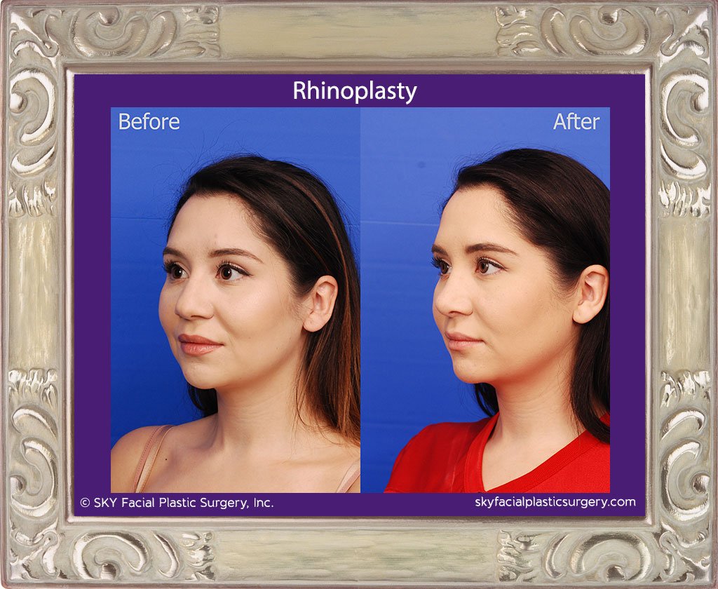 SKY-Facial-Plastic-Surgery-Rhinoplasty-51C.jpg