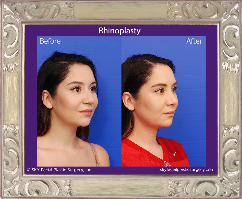 SKY-Facial-Plastic-Surgery-Rhinoplasty-51D.jpg