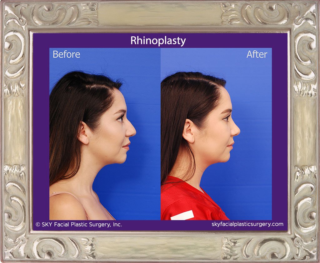 SKY-Facial-Plastic-Surgery-Rhinoplasty-51E.jpg
