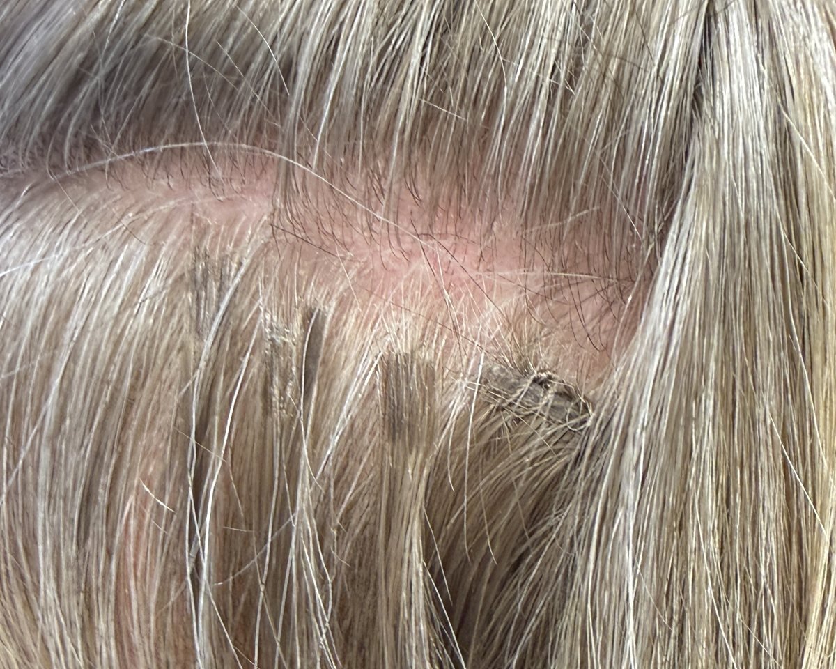 Tiny V-light extension bonds placed along a client's thinning part