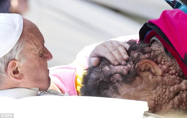 Pope Francis comforts a man with neurofibromatosis