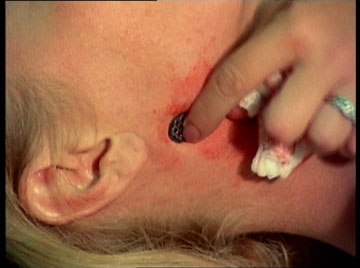 The very latest in hickey removal science.
