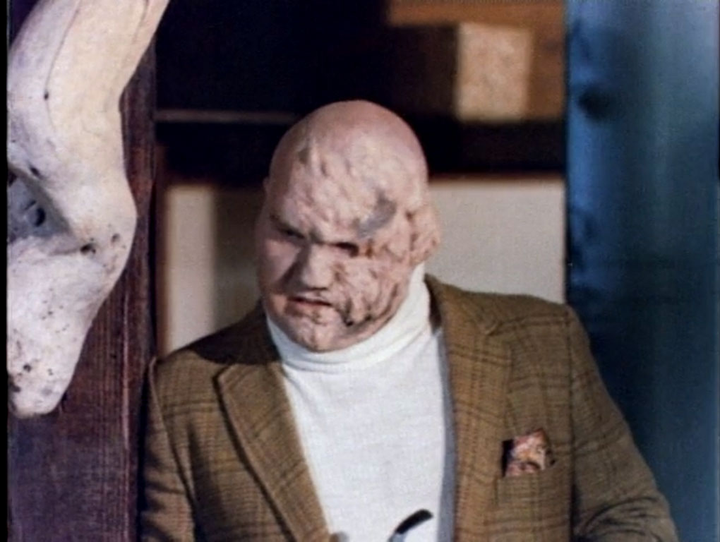 Dude, see a dermatologist.