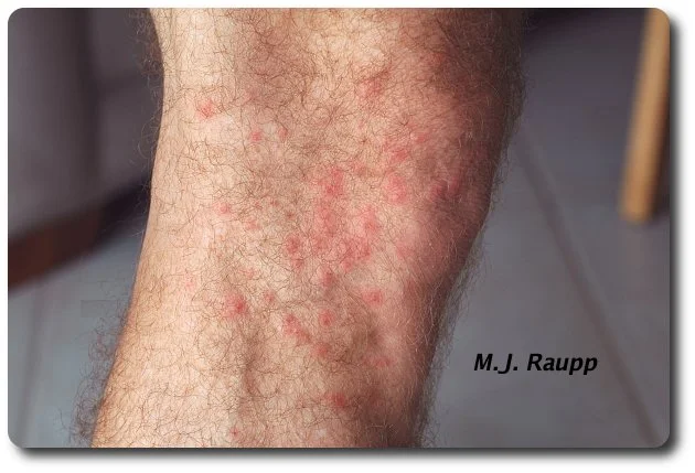 Three days after a fire ant attack my leg was red and itchy.